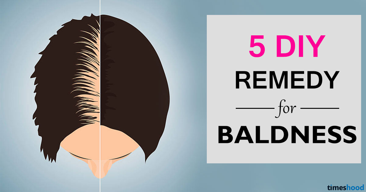 5 DIY to cure baldness. How to regrow hair on bald spot fast. Get rid of baldness in male and female.