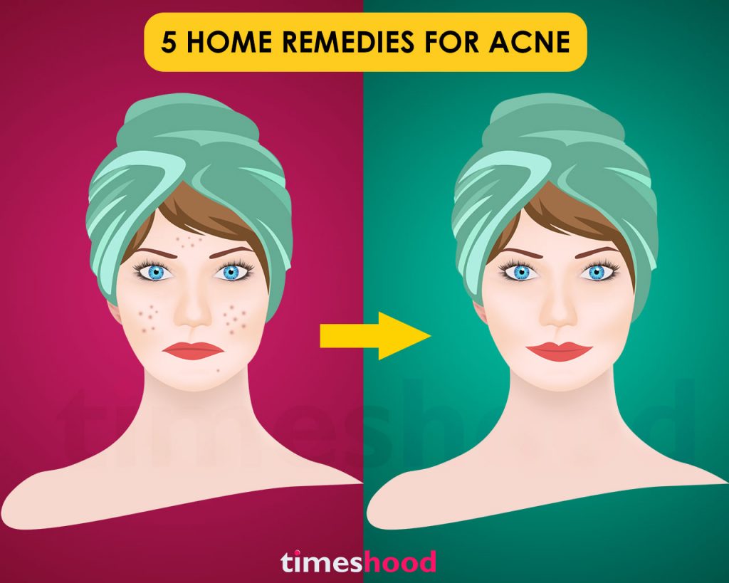 Trying hard to get rid of acne and pimples at home? Get glowing spotless skin with these anti-acne remedies. Easy to use remedies to reduce your pimples at home.